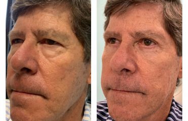 Eyelid Surgeons of Tampa Bay